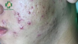 Mun-trung-ca-muc-do-nang-nen-uong-isotretinoin-Doctor-Acnes.jpg